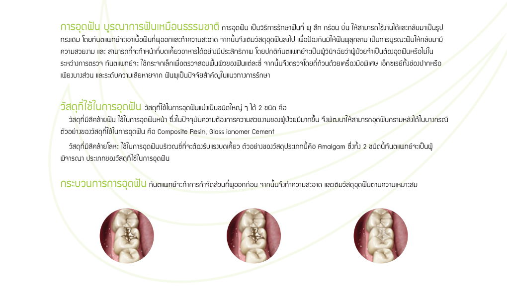 บริการอุดฟัน